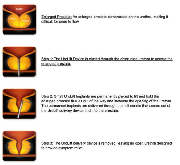 UROLIFT East Valley Urology Center of Arizona