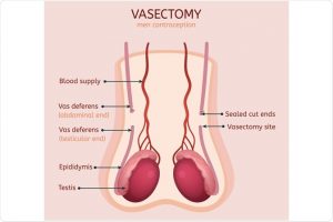 vasectomy in Queen Creek, AZ