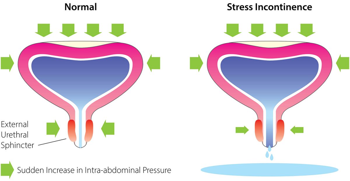 Bulkamid Arizona treatment for Female Stress Urinary Incontinence
