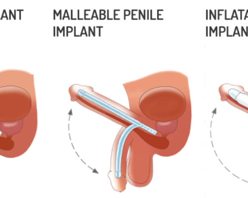 penile-implants-3-types_orig penile-implants-3-types_orig